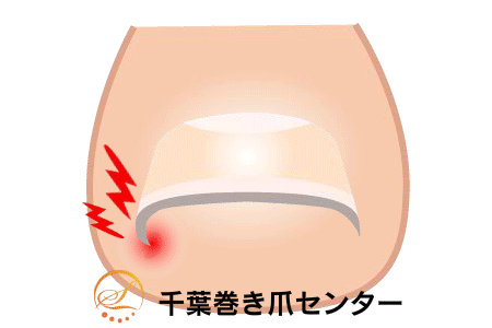 巻き爪矯正の図解